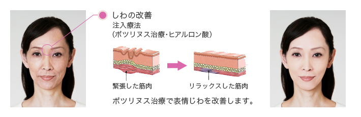ボツリヌス治療の効果