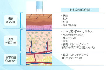 Dermapenによる治療の適用